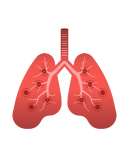 Simplified illustration of the lungs, BEconneCTD-ILD Study, interstitial lung disease, connective tissue disease